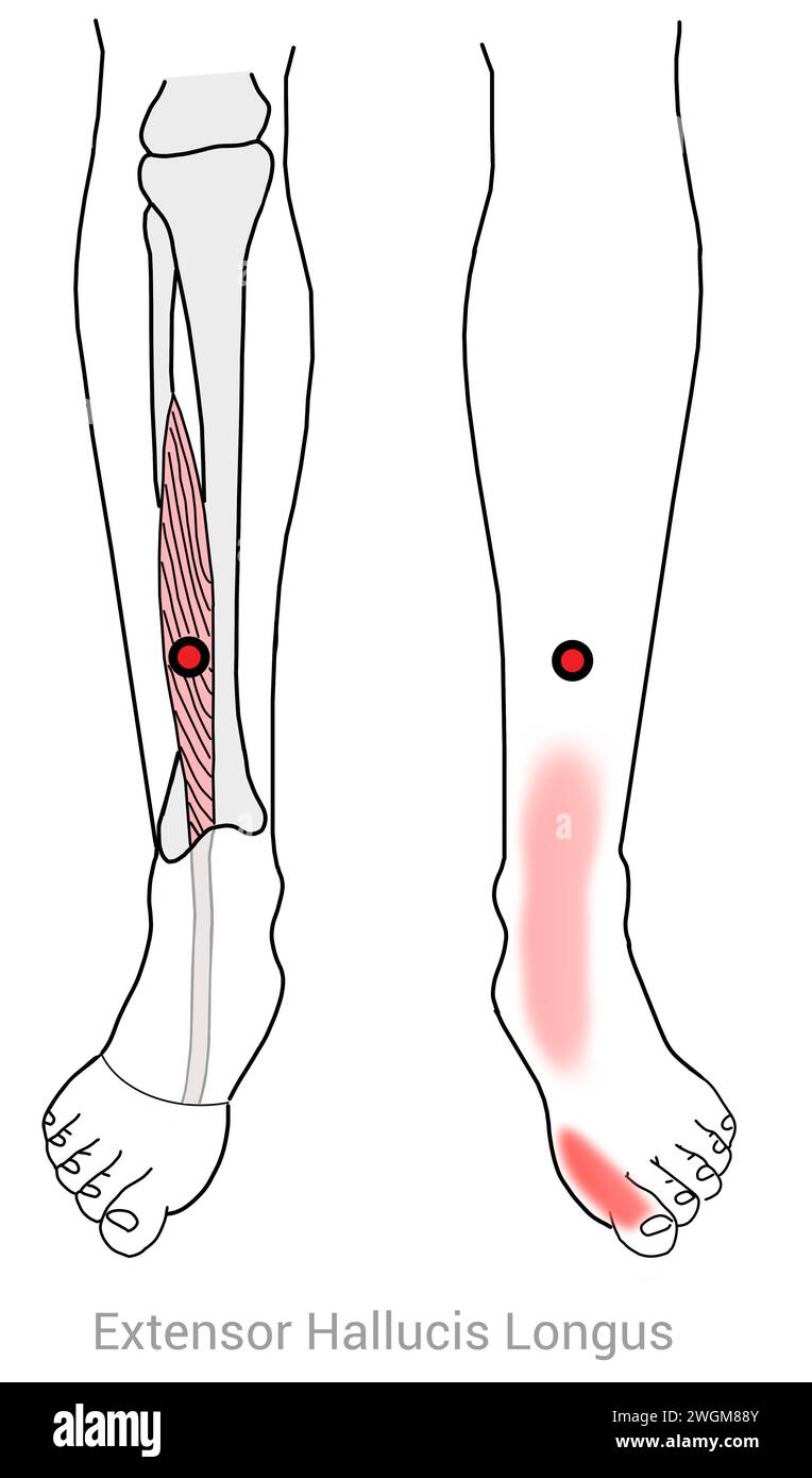 Extenseur hallucis Longus : points déclencheurs myofasciaux causant des douleurs dans le gros orteil et d'autres emplacements de douleur associés Banque D'Images