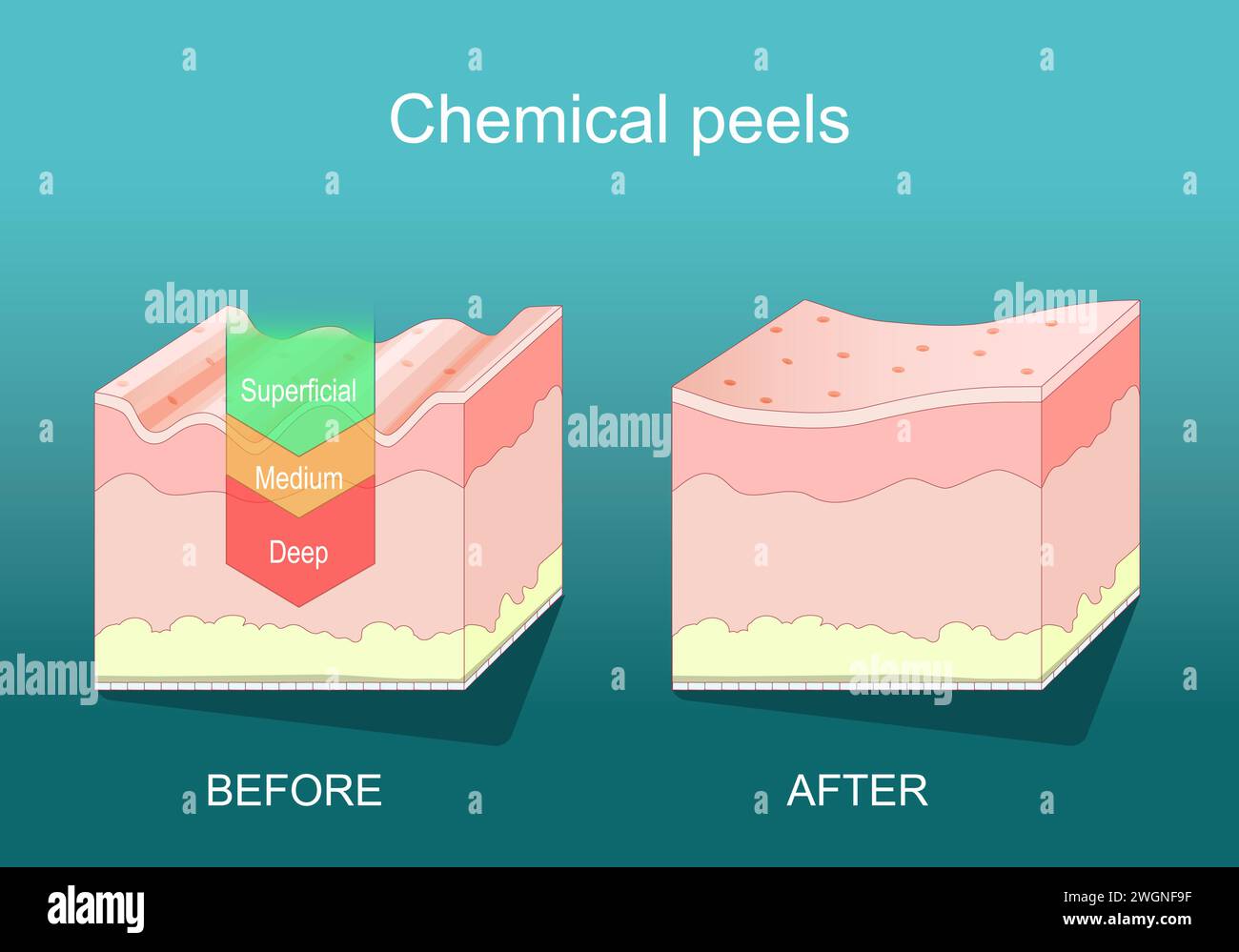 Peeling chimique. Traitement esthétique de beauté. Peau profonde, moyenne, superficielle. Procédé dermatologique de rajeunissement cutané. Exfoliation. Section transversale Illustration de Vecteur