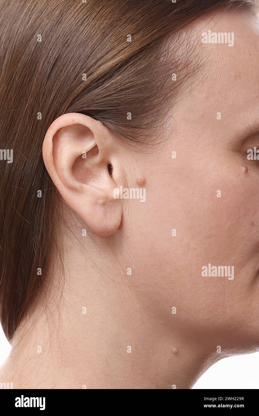 Grandes verrues du naevus sur le visage et le cou de la femme caucasienne, concept de néoplasmes bénins ou malins sur la peau humaine, examen régulier et traitement dans le derme Banque D'Images