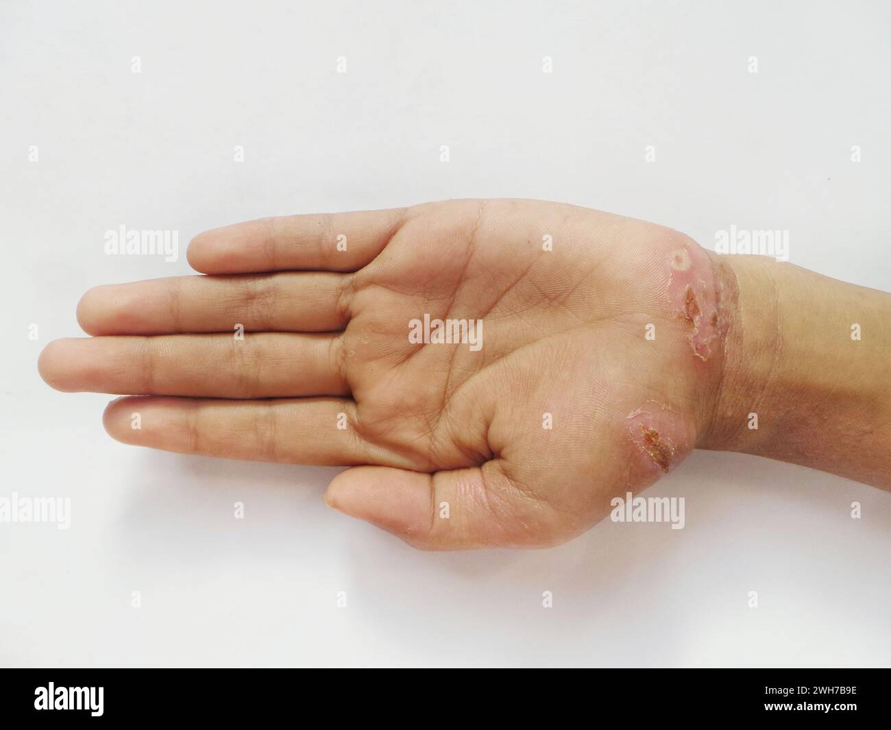 La peau sur les mains pele en raison des croûtes crevasses, les paumes démangent des allergies Banque D'Images