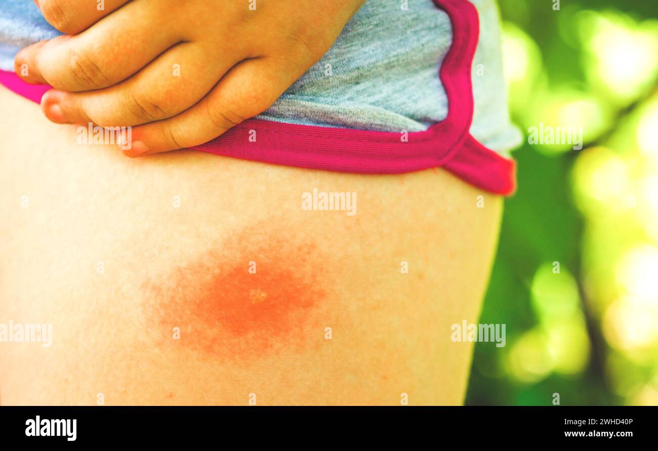 La piqûre de tique sur la jambe d'un enfant, gros plan. Allergie aux piqûres d'insectes. Plaie et conséquences après piqûre de moustique. Peau acnéique Banque D'Images
