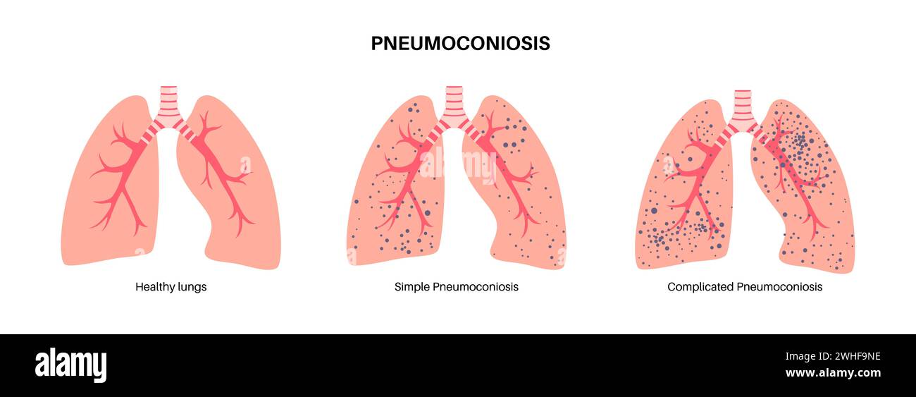 Pneumoconiose pulmonaire, illustration Banque D'Images