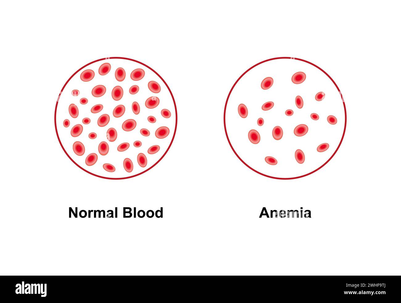 Sang normal et anémique, illustration Banque D'Images