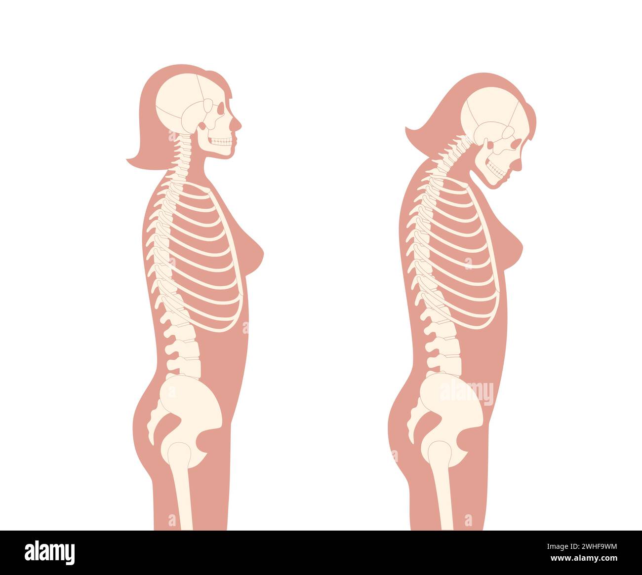 Déformation des vertèbres cervicales, illustration Banque D'Images