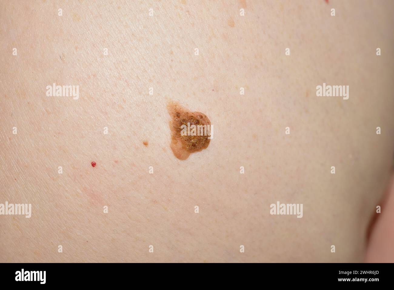 Un instantané d'une grosse taupe brune située sur le ventre d'une femme. Banque D'Images