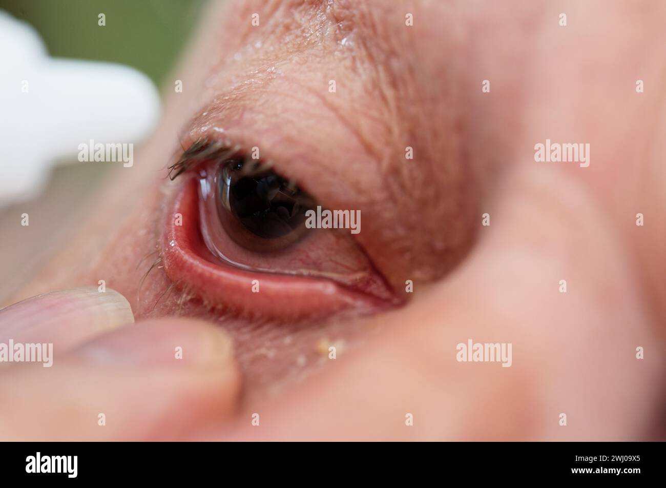 La pupille d'un homme est encore dilatée après une chirurgie de la LIO, un remplacement de lentille intraoculaire. Il prend ses premières gouttes pour les yeux. Son œil est très rouge Banque D'Images