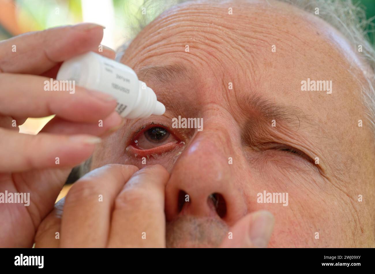 Un homme se fait mettre des gouttes dans l'œil après une chirurgie de la cataracte Banque D'Images