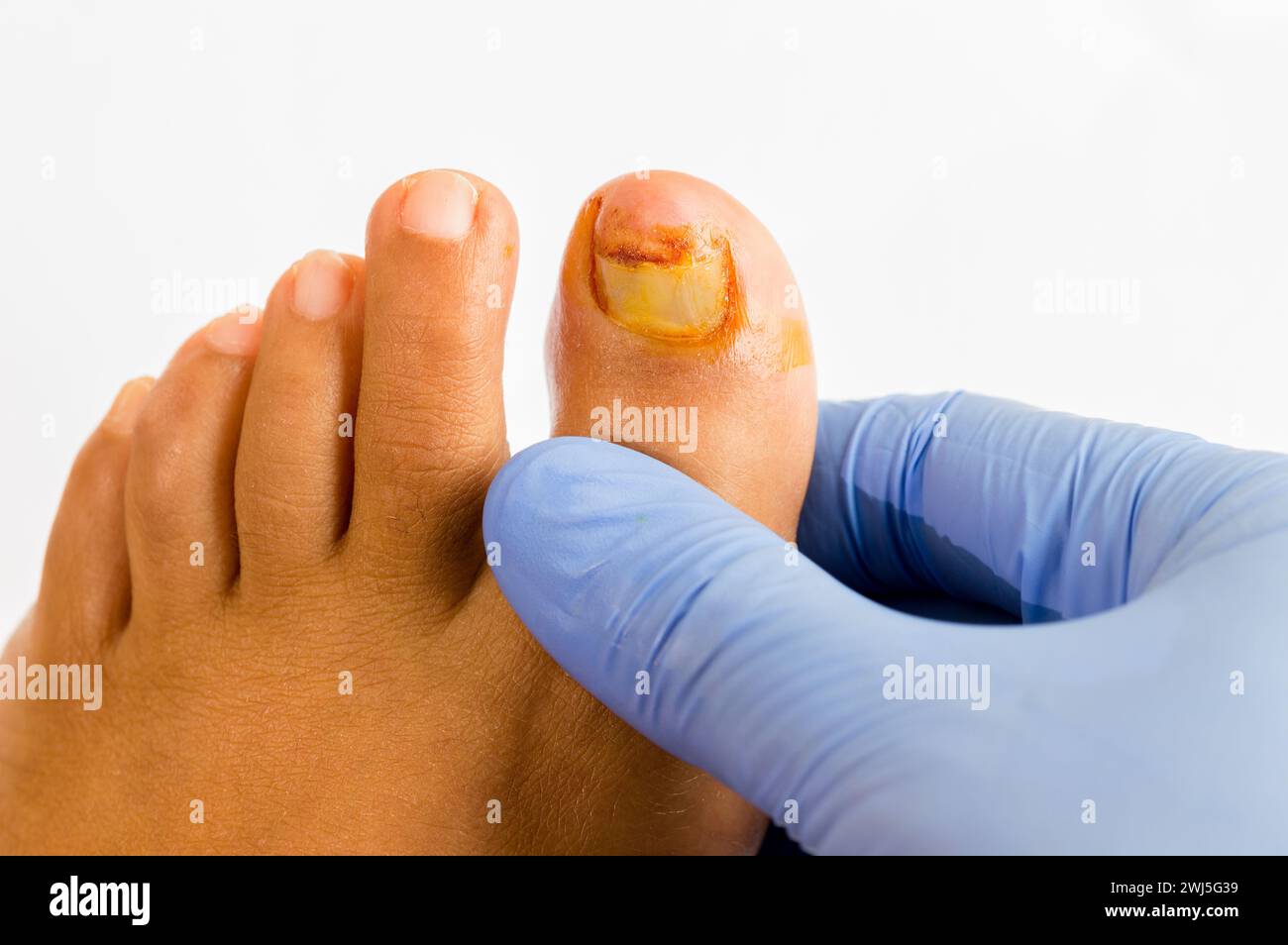 Gros plan du médecin qui contrôle l'orteil gauche qui souffre d'un ongle cassé Banque D'Images