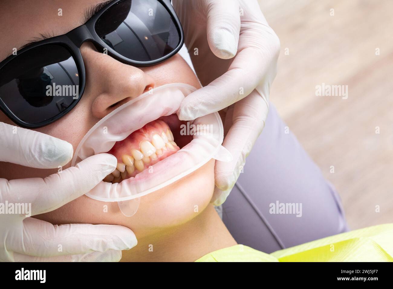 Dentiste installant un rétracteur de joue de patient dans un cabinet de dentiste Banque D'Images Dentiste installant un rétracteur de joue de patient dans un cabinet de dentiste Banque D'Images