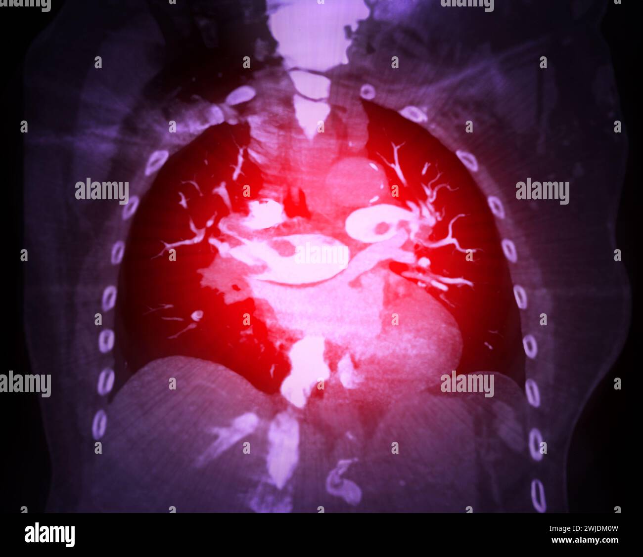 Une artère pulmonaire TDM révèle une vue détaillée des vaisseaux sanguins pulmonaires, capturant la présence d'une embolie pulmonaire, une condition où une cl de sang Banque D'Images