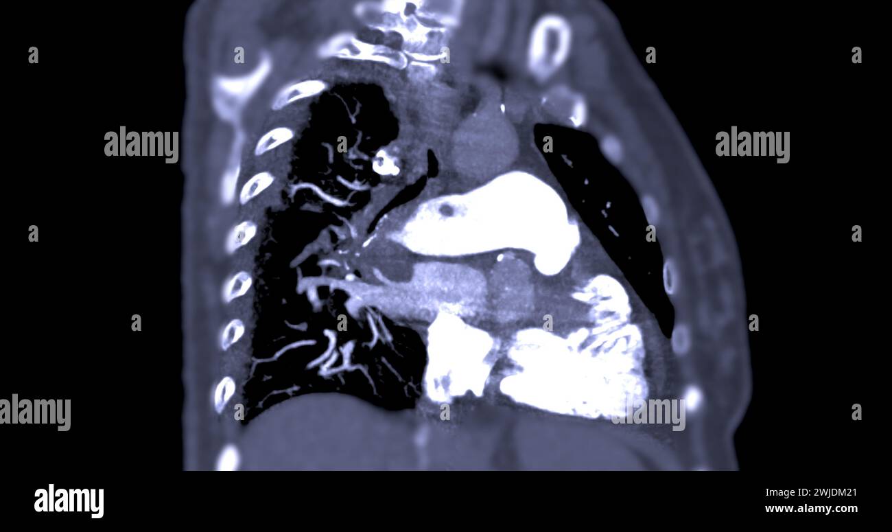 Une artère pulmonaire TDM révèle une vue détaillée des vaisseaux sanguins pulmonaires, capturant la présence d'une embolie pulmonaire, une condition où une cl de sang Banque D'Images