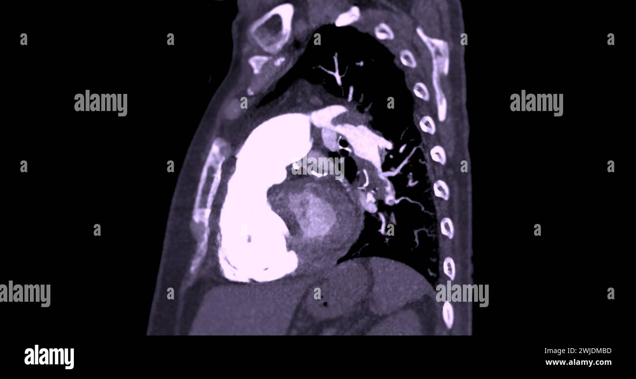 Une artère pulmonaire TDM révèle une vue détaillée des vaisseaux sanguins pulmonaires, capturant la présence d'une embolie pulmonaire, une condition où une cl de sang Banque D'Images