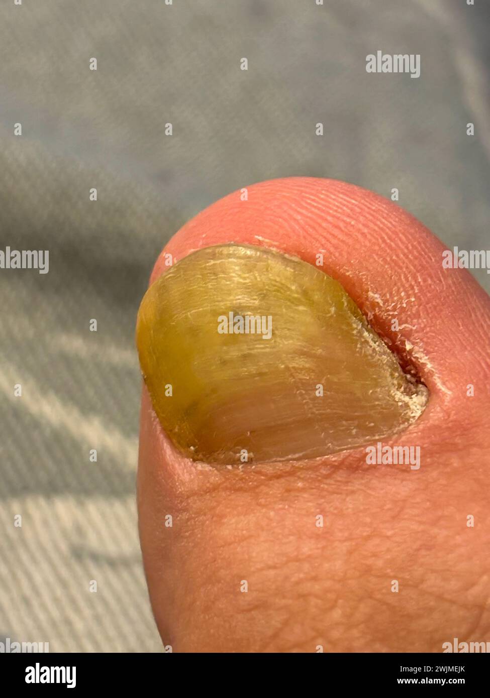 Mycose unguéale en gros plan, Onychomycose, infection fongique de l'unité unguéale. Banque D'Images