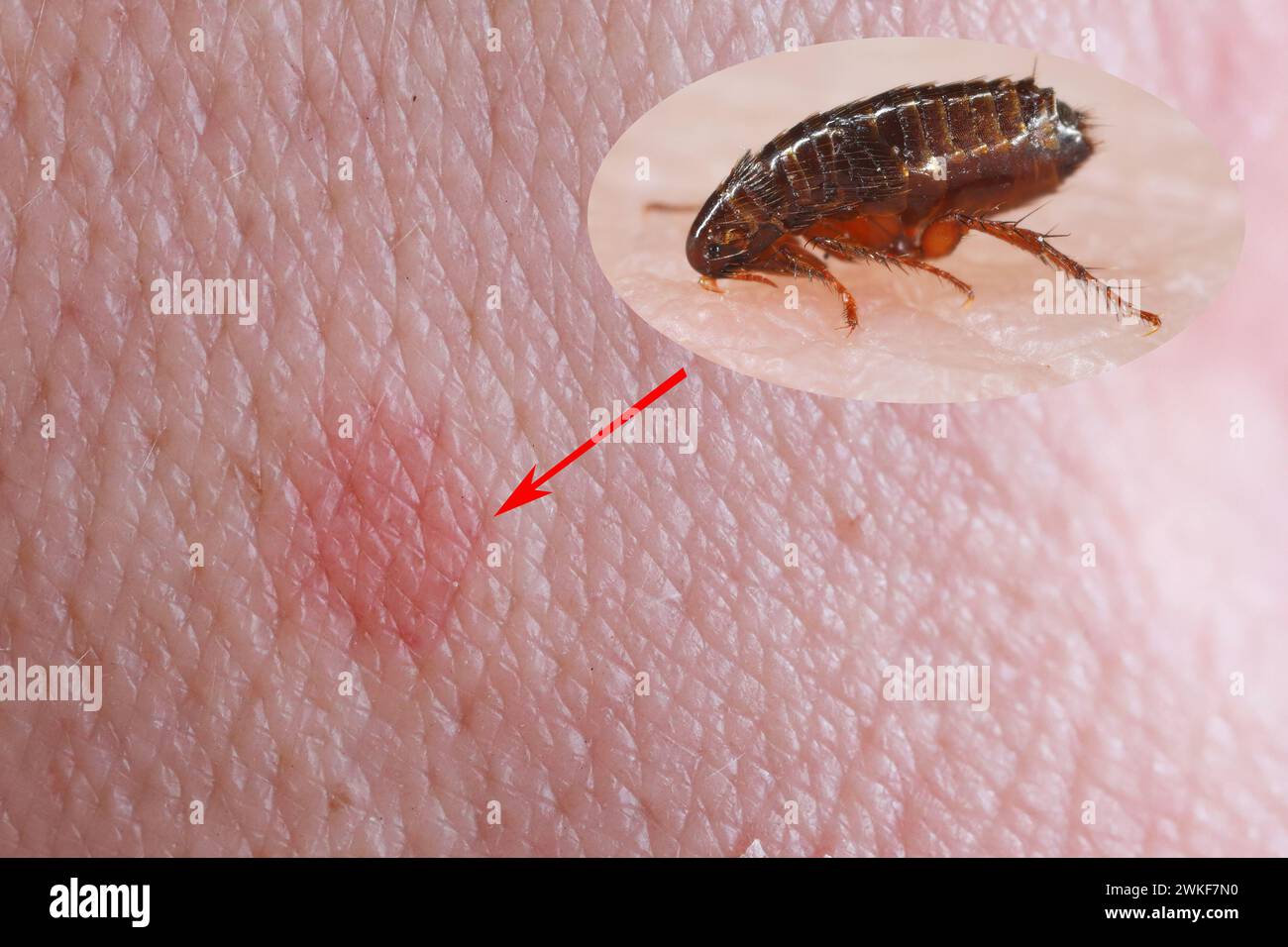 Une puce mord sur la peau de la main humaine, buvant du sang et provoque des rougeurs de la peau à l'endroit de la morsure. Porteur de microorg pathogène Banque D'Images