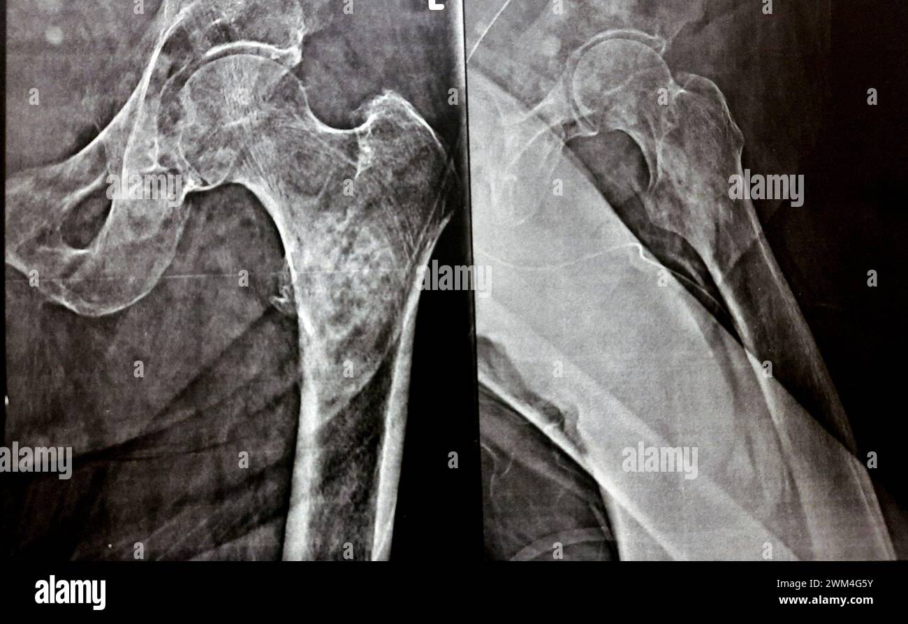 Radiographie simple avec une forte probabilité de fracture sous-trochantérienne, de fracture trochantérienne et de métastase maligne dans la partie médiane de la diaphyse fémorale en dessous Banque D'Images