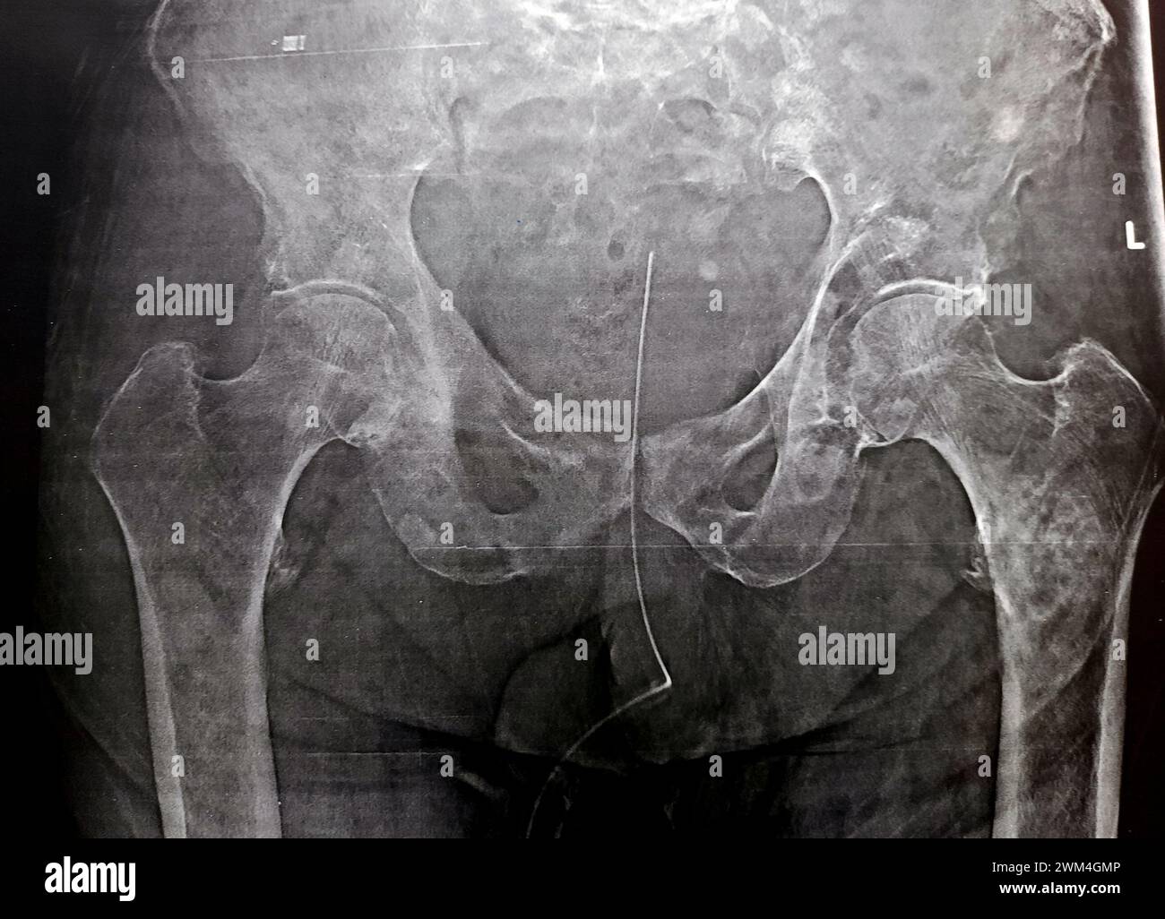 Forte probabilité de fracture sous-trochantérienne, de fracture trochantérienne et de métastase maligne dans la face médiale de la diaphyse fémorale supérieure d'un patient âgé Banque D'Images