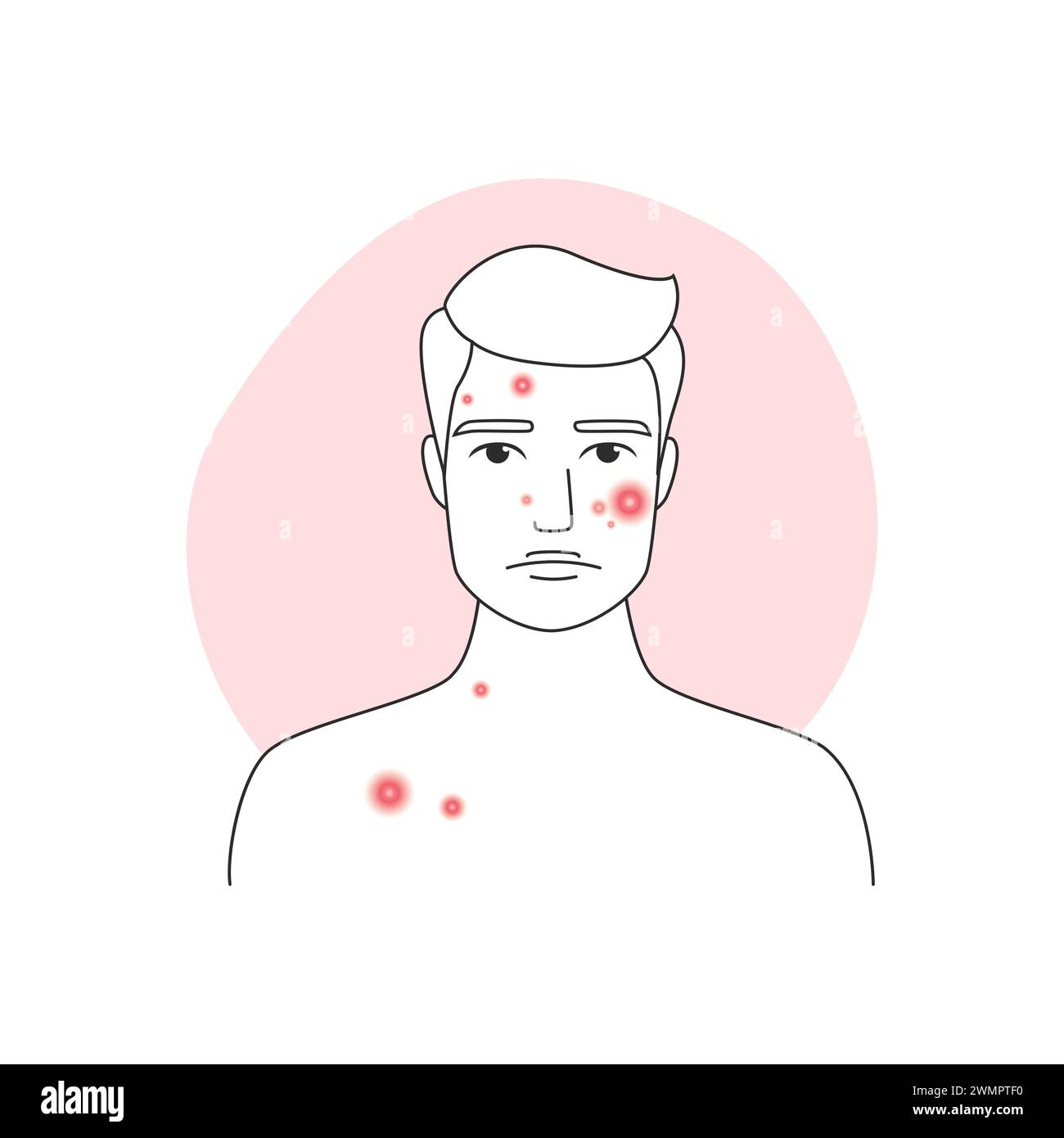 Homme triste avec l'acné et la dermatite de la peau du visage avant l'illustration vectorielle de traitement Illustration de Vecteur