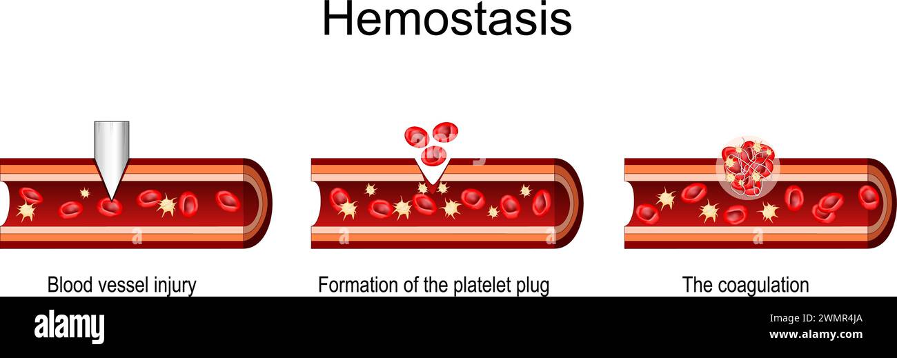 Hémostase. Coupe transversale d'un vaisseau sanguin après lésion, formation du bouchon plaquettaire, coagulation et cicatrisation. Illustration vectorielle Illustration de Vecteur