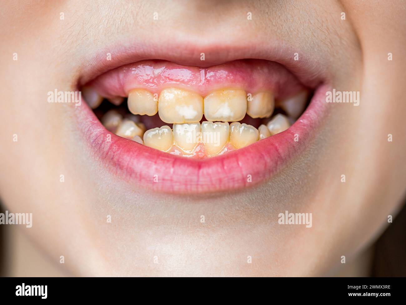 Gros plan des dents malsaines de bébé. Ouvrez la bouche d'un petit garçon avec des dents mal poussées en gros plan. Le concept d'orthodontie et de stomatologie. Mauvais Banque D'Images