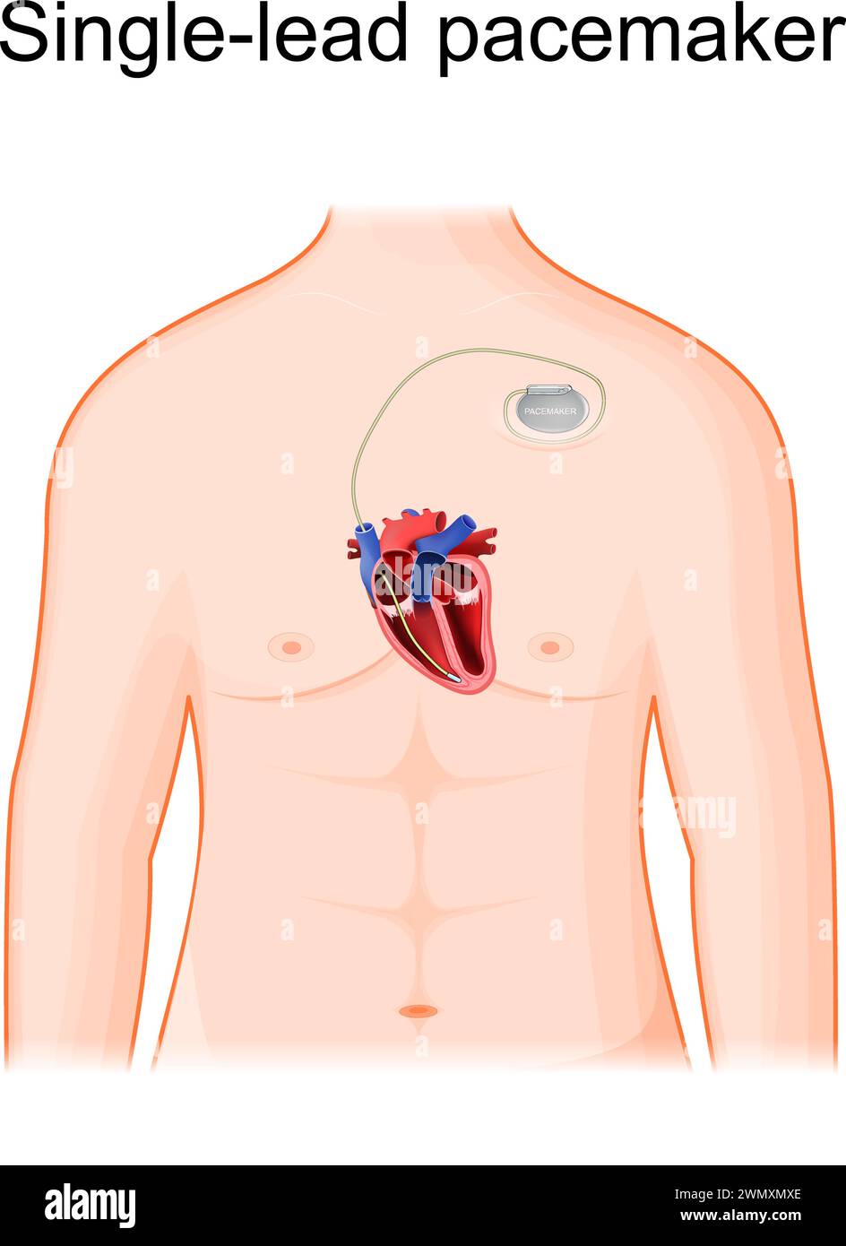 Positionnement d'un stimulateur cardiaque à dérivation unique. Corps humain avec section transversale du coeur et stimulateur cardiaque artificiel. Une seule électrode de stimulation est placée dans un chambe Illustration de Vecteur