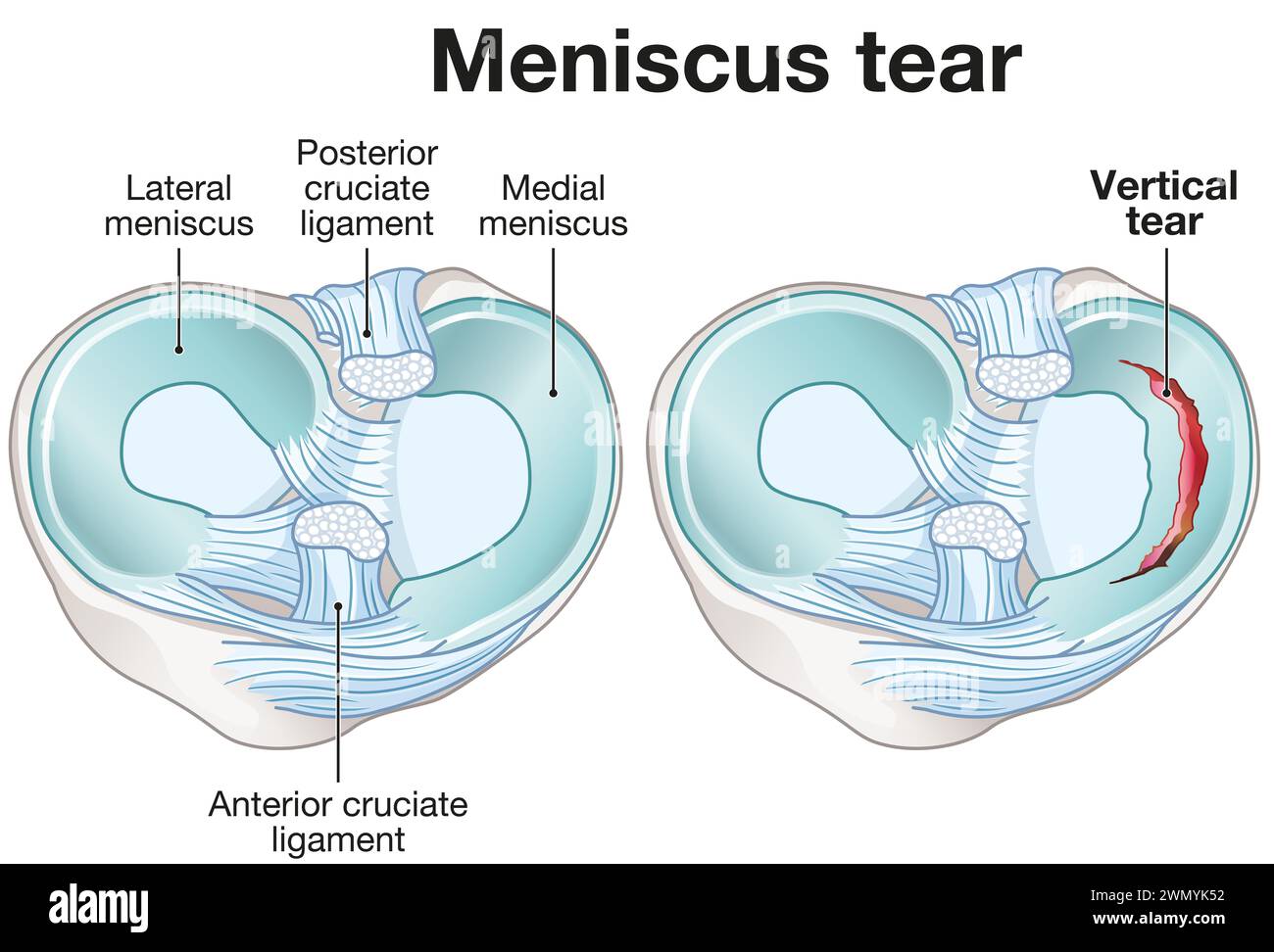 Les ménisques sont des cartilages en forme de C dans les genoux, amortissant et stabilisant les articulations. Les ligaments croisés stabilisent le genou, reliant le cuisse et le tibia. Banque D'Images