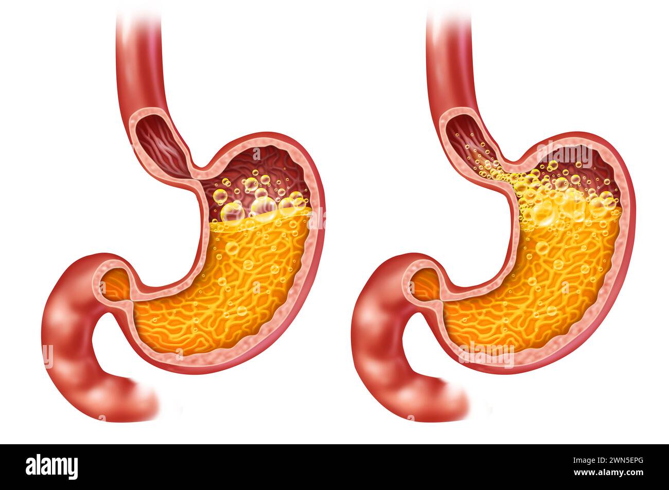 Reflux acide et brûlures d'estomac ou maladie gastro-œsophagienne ou RGO comme un sphincter ouvert avec un œsophage iflamed comme symbole médical de régurgitation Banque D'Images