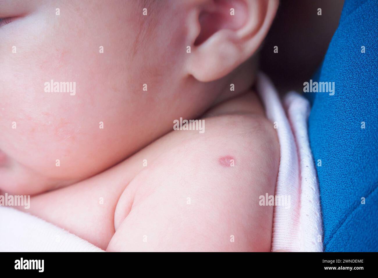 Réaction de vaccination du vaccin BCG de Bacillus Calmette Guérin sur l'épaule du nouveau-né, utilisé contre la tuberculose Banque D'Images