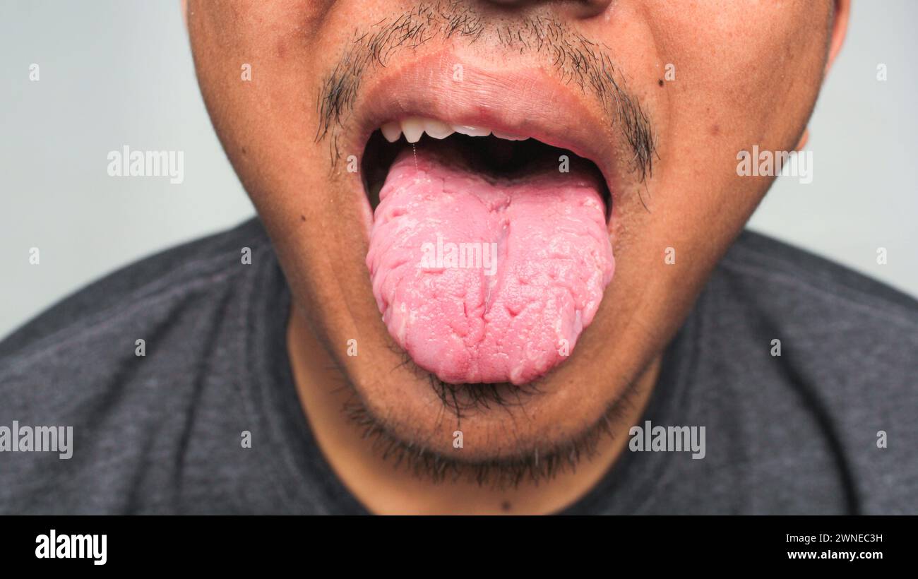 La langue fendue, également connue sous le nom de 'langue scrotale' ou 'lingua plicata', est une condition dans laquelle des lignes ou des rainures ressemblant à des fissures se forment dans la langue Banque D'Images