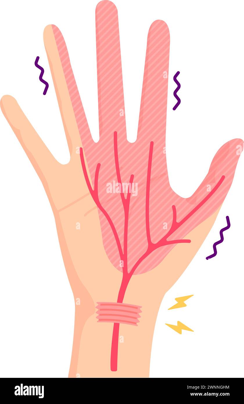 Illustration vectorielle du syndrome du canal carpien Illustration de Vecteur Illustration vectorielle du syndrome du canal carpien Illustration de Vecteur