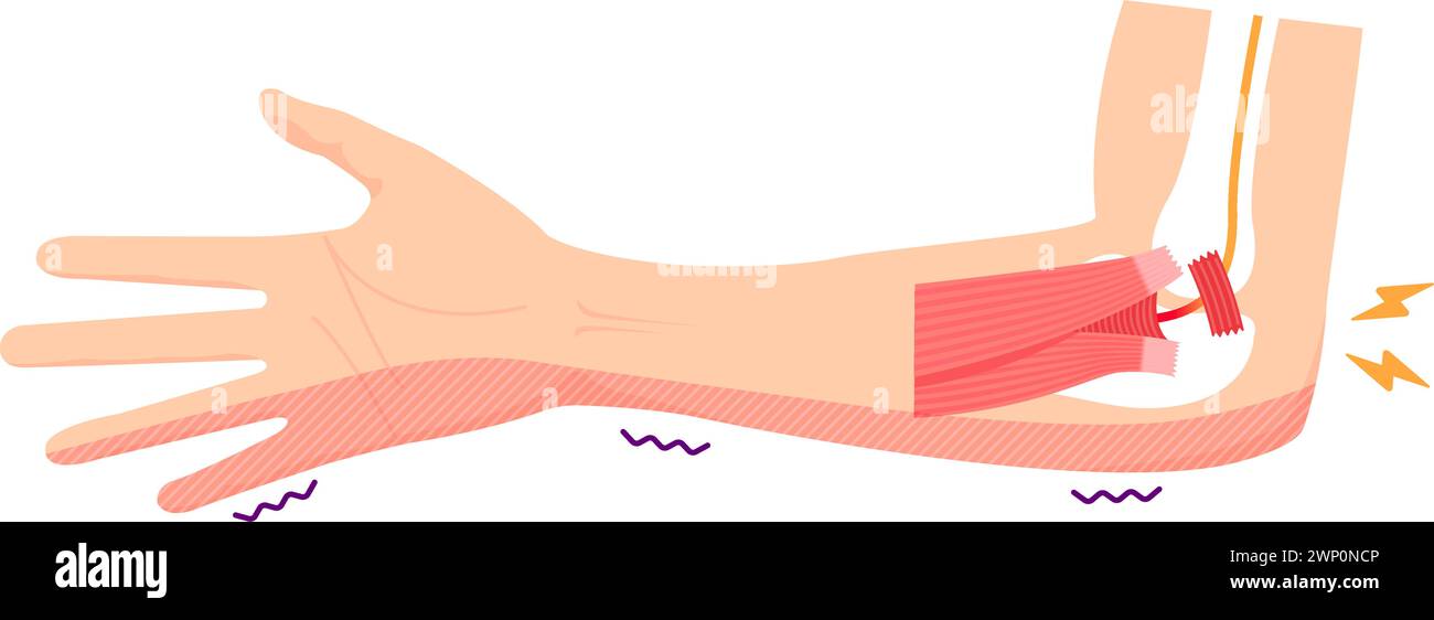 Illustration vectorielle du syndrome du canal cubital Illustration de Vecteur