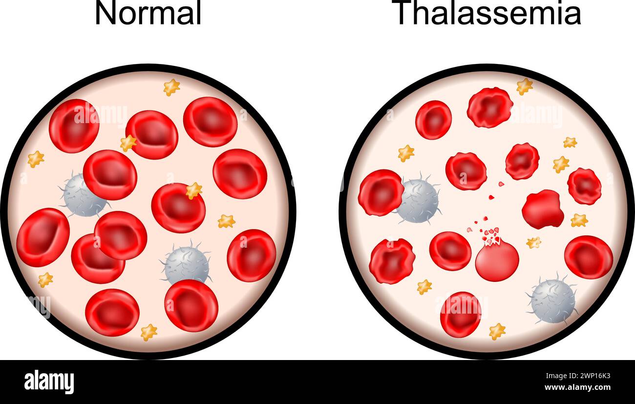 Thalassémie. Gros plan des globules rouges normaux et des globules sanguins endommagés. Les anémies méditerranéennes. Troubles héréditaires du sang entraînant un hémo anormal Illustration de Vecteur