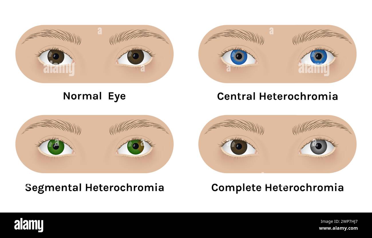 Yeux humains réalistes avec conception d'illustration vectorielle hétérochromie. Différentes couleurs iris, normal, central, segmentaire et complet. Illustration de Vecteur