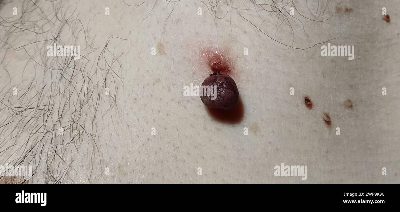 Papillomes sur la peau - un rouge mourant et plusieurs petits néoplasmes. Le traitement des maladies de la peau. Infections virales humaines. Banque D'Images