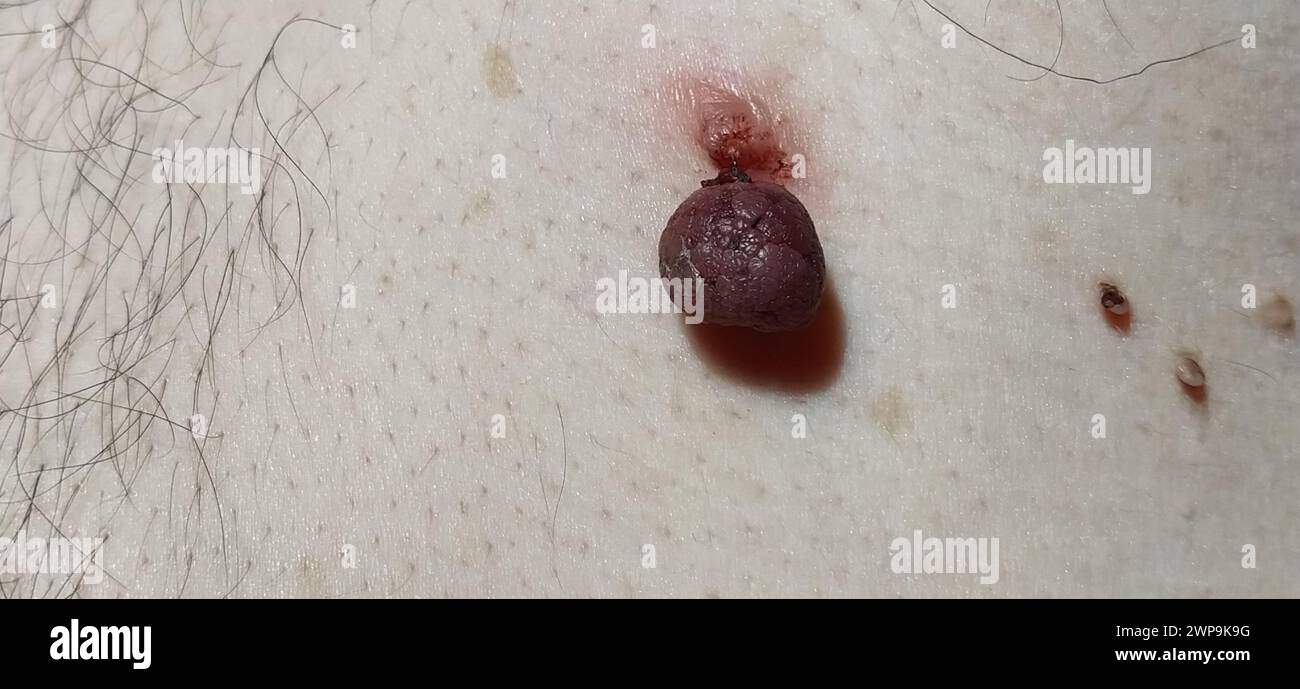 Papillomes sur la peau - un rouge mourant et plusieurs petits néoplasmes. Le traitement des maladies de la peau. Infections virales humaines Banque D'Images