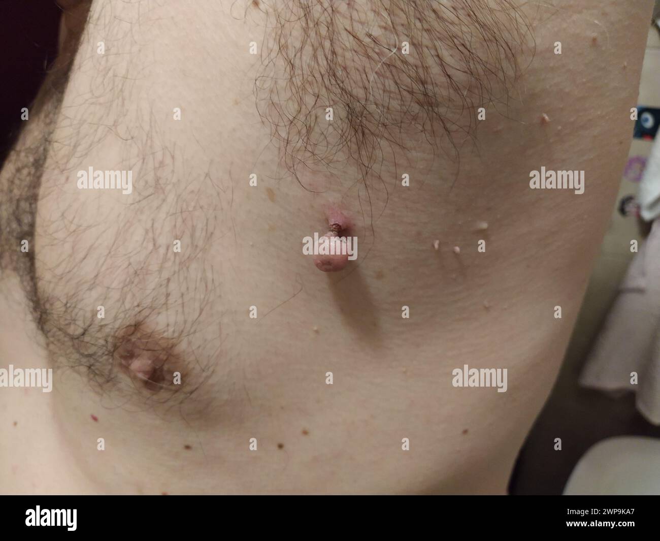 Papillomes sur la peau - un rouge mourant dans la région axillaire et plusieurs petites néoplasmes. Infections virales humaines Banque D'Images