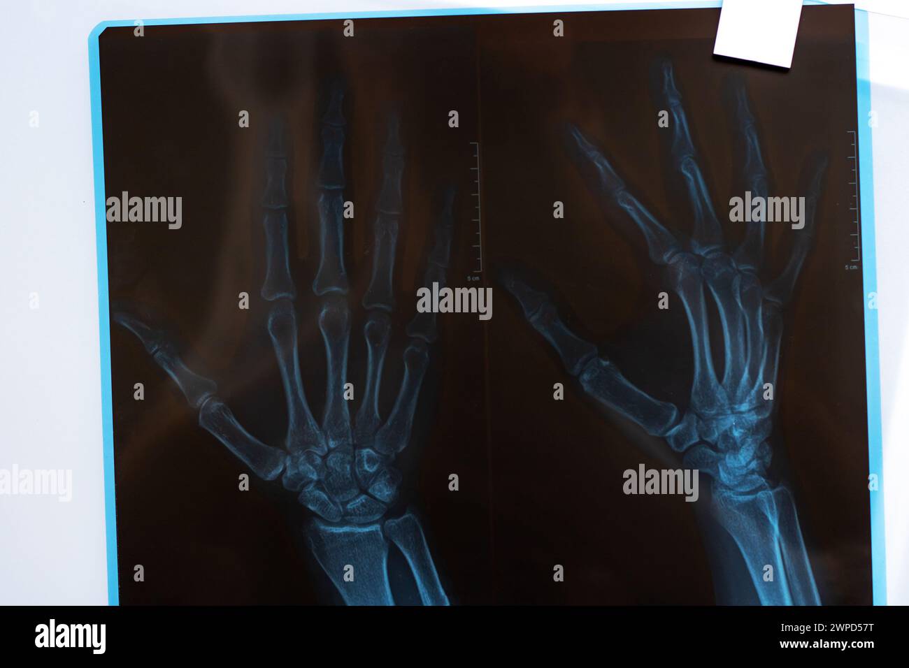 Gros plan radiographie de la main sur un fond gris Banque D'Images