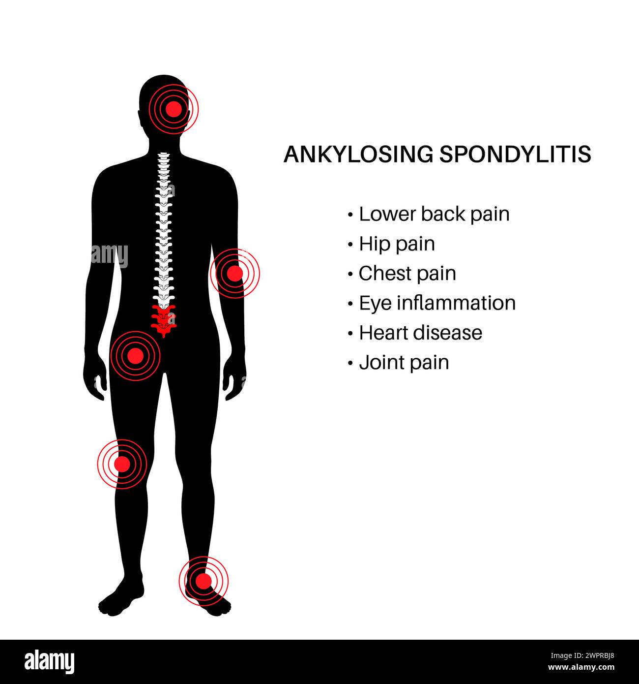 Spondylarthrite ankylosante, illustration Banque D'Images