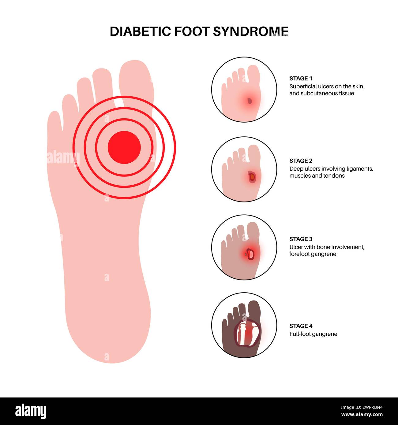 Ulcères du pied diabétique, illustration Banque D'Images