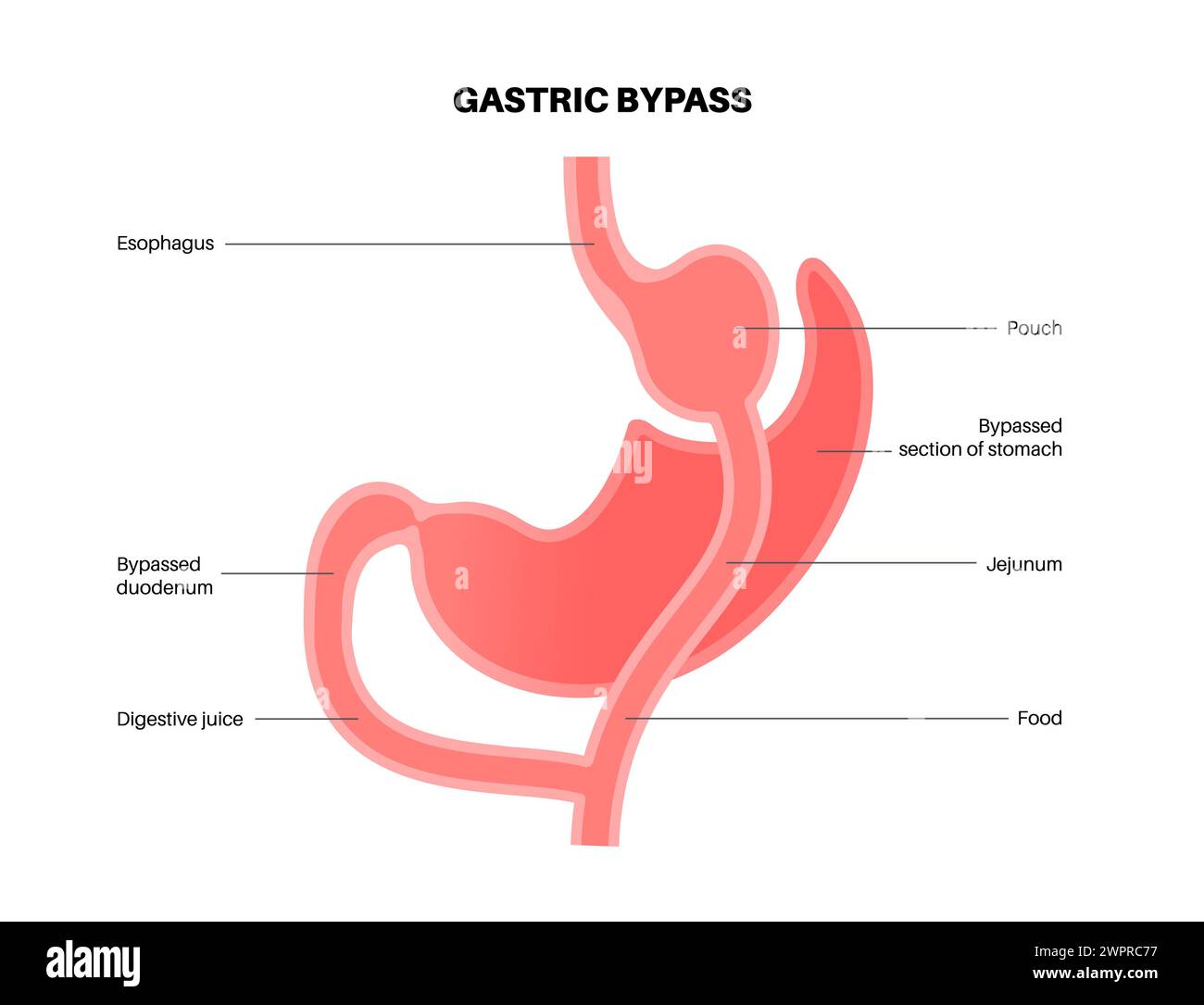 Pontage gastrique, illustration Banque D'Images