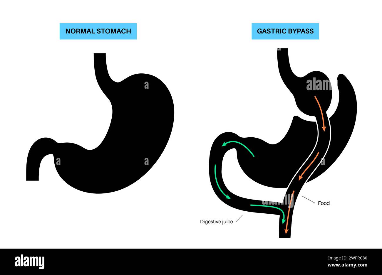 Pontage gastrique, illustration Banque D'Images