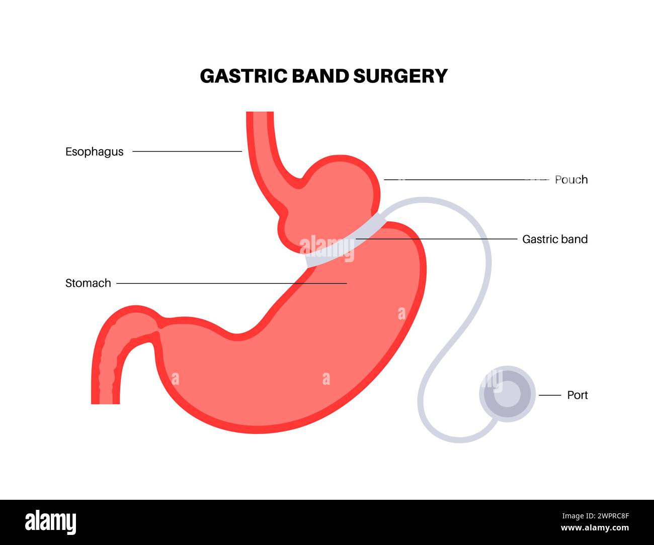 Procédure médicale de bande gastrique, illustration Banque D'Images