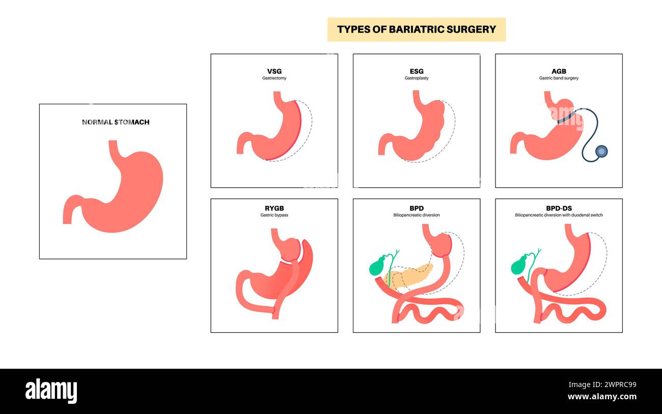 Types de chirurgie bariatrique, illustration Banque D'Images