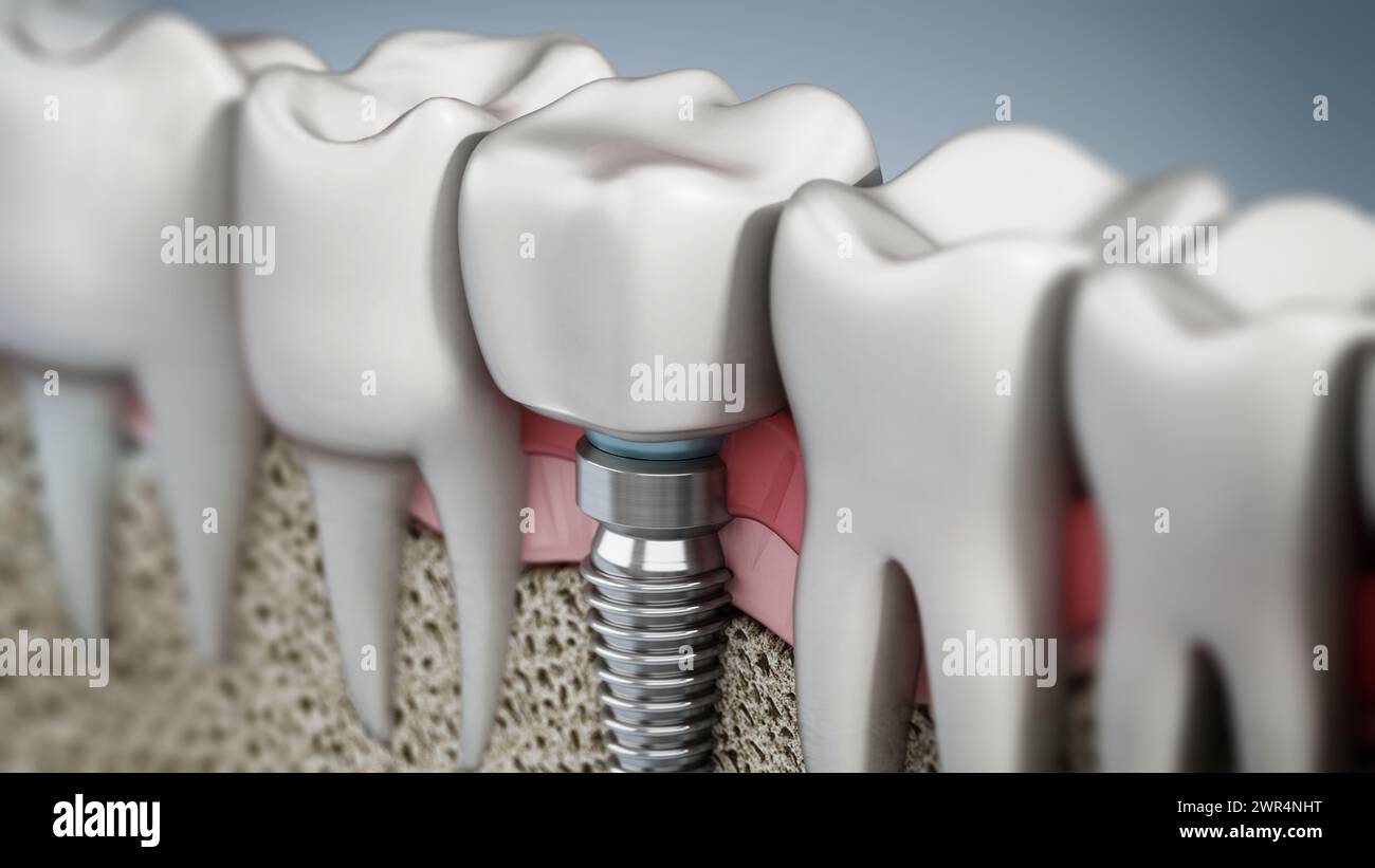 3D rendu de l'implant dentaire montrant la gomme de la mâchoire et les couches osseuses.3D illustration. Banque D'Images