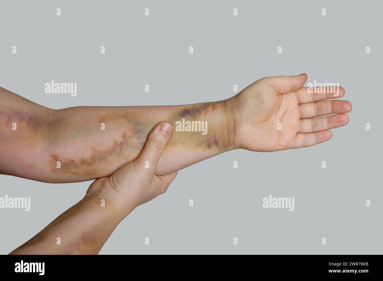 Main féminine avec ecchymose d'accident de voiture Banque D'Images