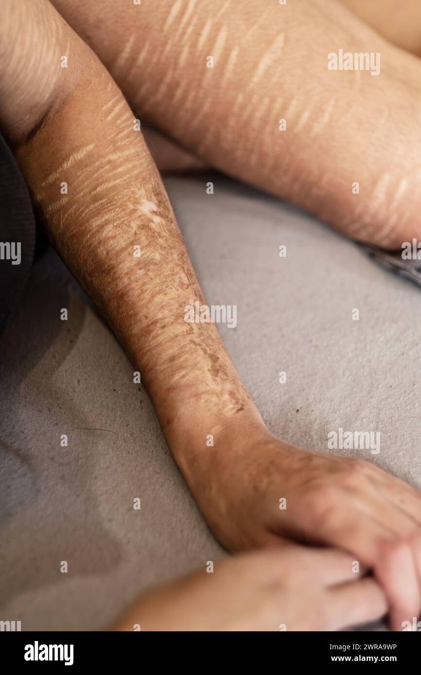Bras et jambe d'une femme avec de lourdes coupures et cicatrices d'automutilation dans la frustration, l'auto-maltraitance, trouble de personnalité limite Banque D'Images