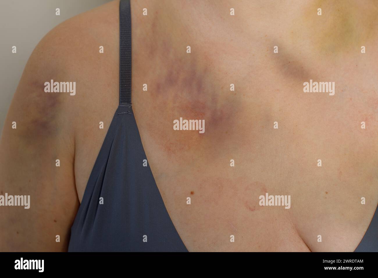 Corps féminin avec ecchymose d'accident de voiture Banque D'Images