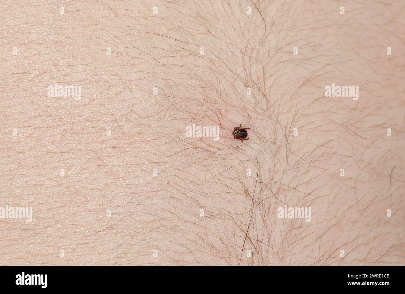 La tique d'Ixodidae repose sur le ventre d'un homme lors d'une promenade dans la forêt. Banque D'Images