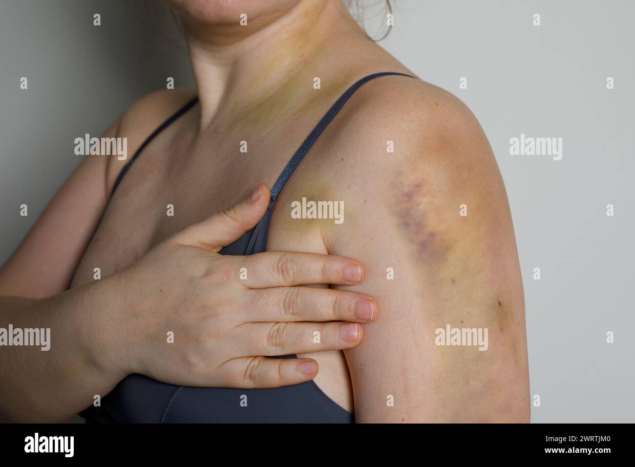 Épaule féminine avec ecchymose d'accident de voiture Banque D'Images