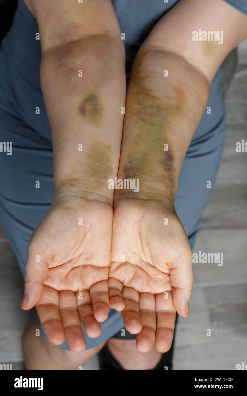 Main de femme avec ecchymose d'accident de voiture Banque D'Images