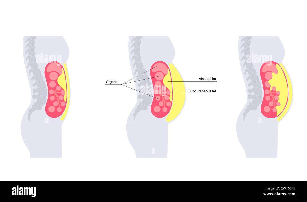 Schéma de la graisse viscérale, illustration. La graisse du ventre entoure les organes internes dans la cavité abdominale. Banque D'Images